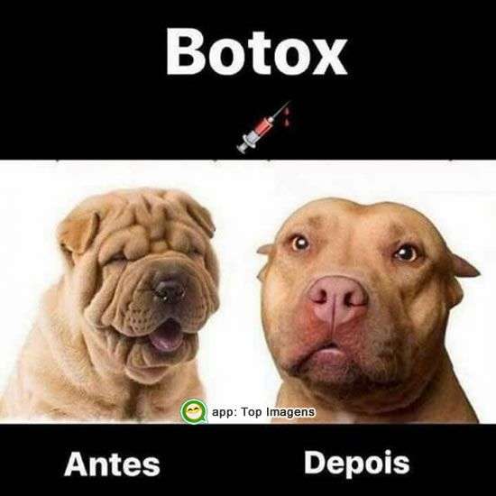 Botox antes e depois